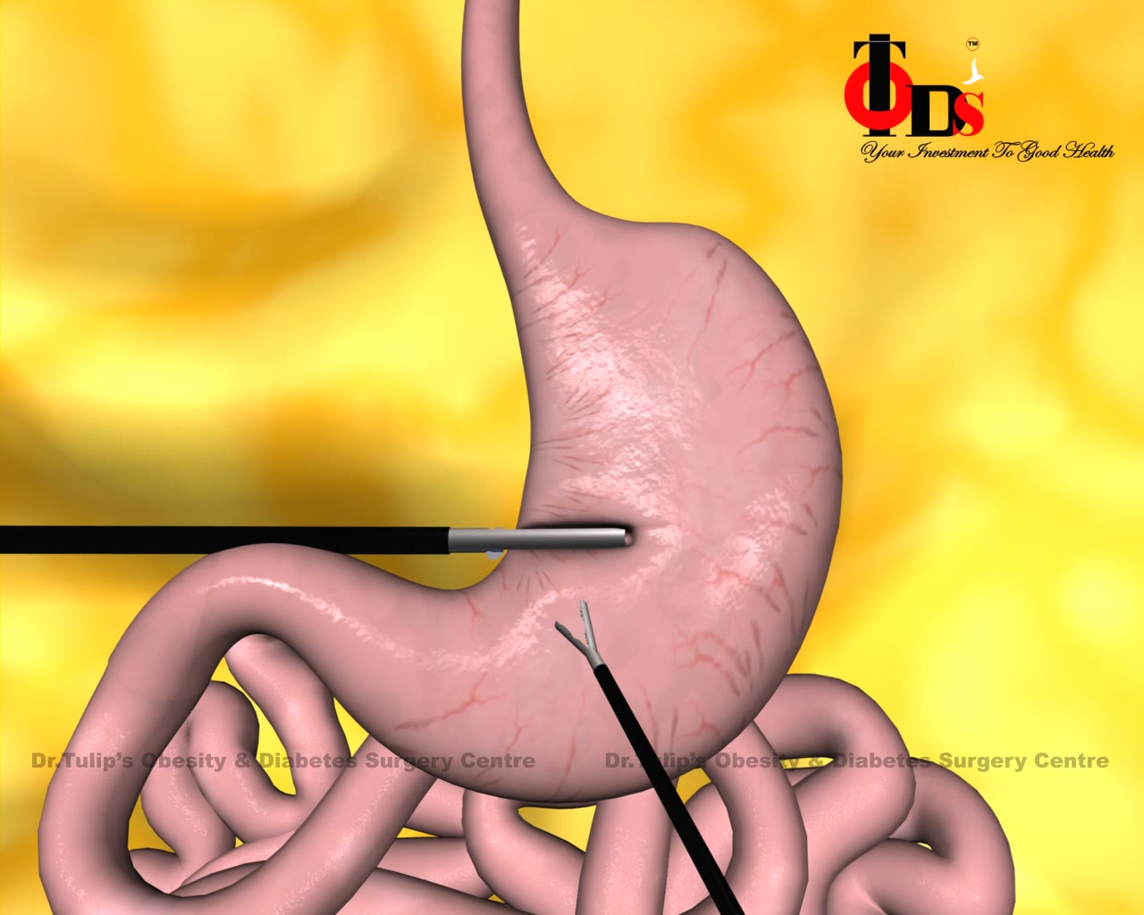  Haital Hernia surgery